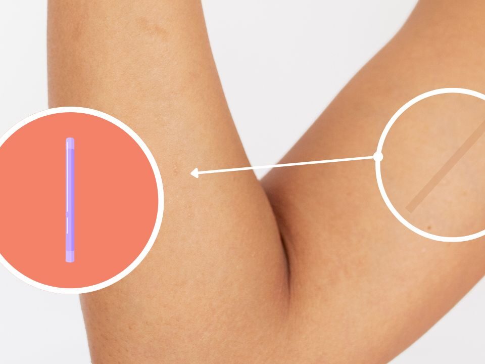 local que é colocado o implanon no braço da mulher