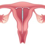 como fica o DIU dentro de um utero