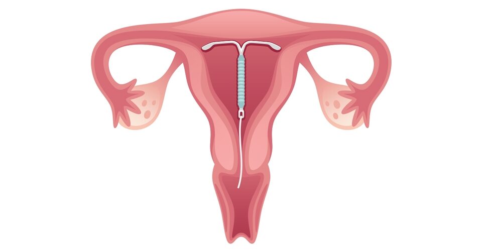 como fica o DIU dentro de um utero